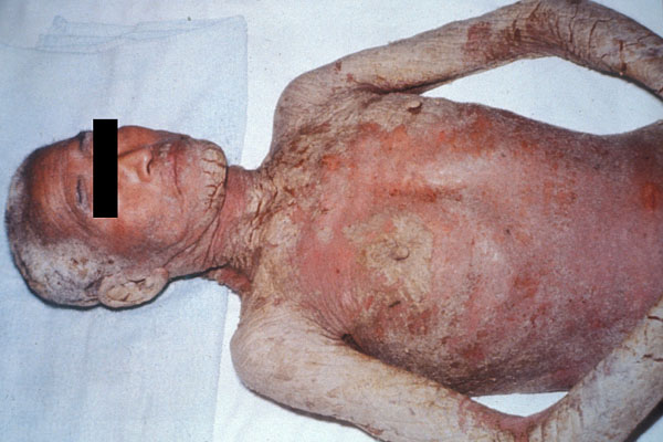 Norwegian-scabies-pictures-39.jpg