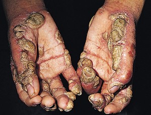 Norwegian-scabies-pictures-32.jpg
