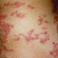 Uncinaria stenocephala LarMig.jpg