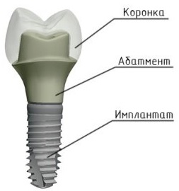 Абатмент.jpg